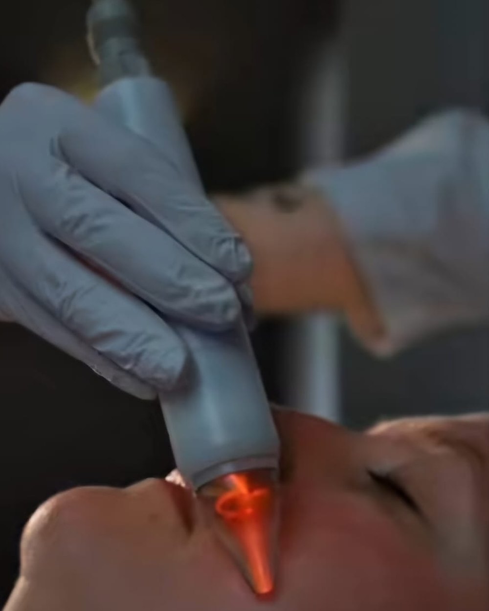 Cold Plasma Behandlung mit dem Plasma-Pen im Gesicht