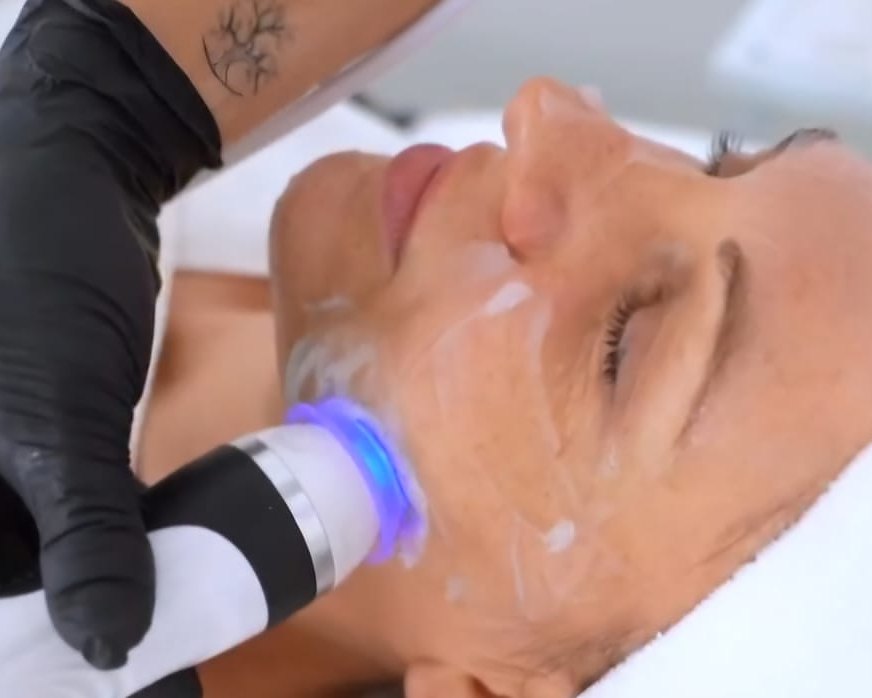 Skin OXYmizer Anwendung im Gesicht mit Sauerstoff und Wirkstoffen