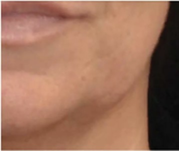 Mund- und Kinnpartie nach der Behandlung mit dem INFUZION System