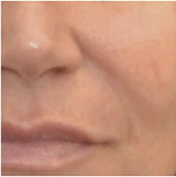 Wange und Nasolabialfalte nach der Behandlung mit dem INFUZION System