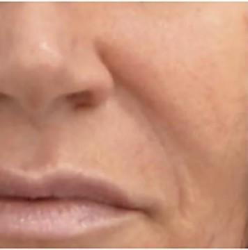 Wange und Nasolabialfalte vor der Behandlung mit dem INFUZION System